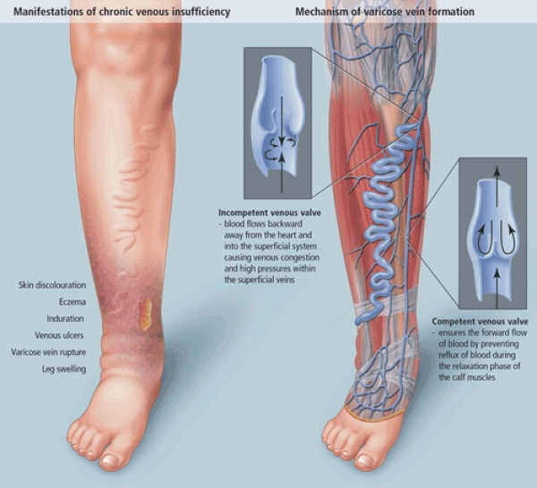 secțiunea cezariană și picior varicos