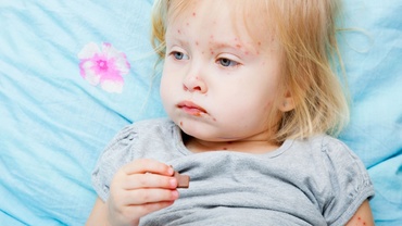 Raport OMS: România principalul focar de infecţie cu rujeolă din Europa