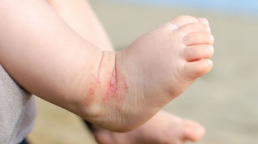 Experienţă noastră cu dermatita atopică