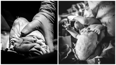 Fotografii impresionante din sala de naştere. Efectele naşterii naturale asupra capului bebeluşului