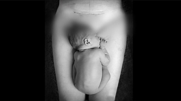 Dragă mamă care ai născut prin cezariană…