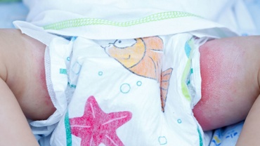 Eritemul fesier. Ce este şi cum poate fi tratat