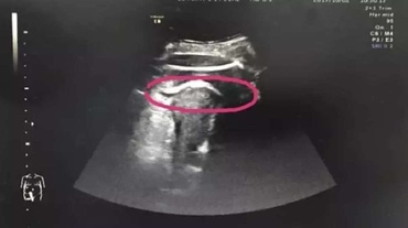 O femeie însărcinată, la un pas de moarte după o lovitură puternică a fătului