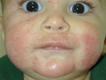 Eczeme - cauze si prevenire