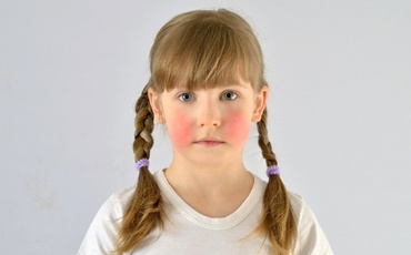 Sindromul obrajilor pălmuiți – cauze, simptome, diagnostic și tratament