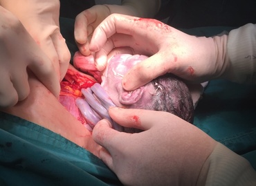 Cordonul ombilical în jurul gâtului – motiv de cezariană sau nu?