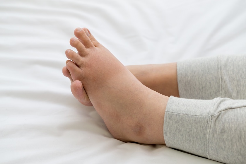 Picioare umflate - cauze, prevenire si tratamente