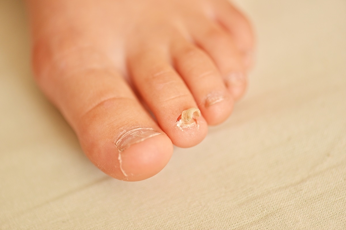 ciuperca unghiei de la picior cum să îndepărtezi unghia de la picioare