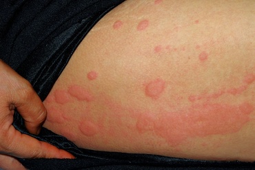 Urticaria, în timpul sarcinii: cauze, tratament și remedii naturale