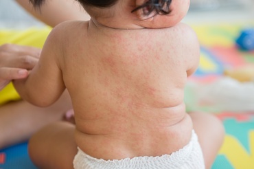 Roseola infantum – simptome, cauze și prevenire