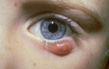 Chistul pleoapelor - prevenire si tratament