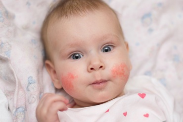 Se poate transmite dermatita atopică de la părinți la copii?