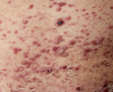 Pitiriazisul lichenoid, la copii. Cauze, simptome și tratament