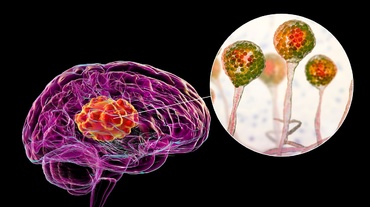 Pediatrii avertizează părinții cu privire la infecțiile creierului, la copii