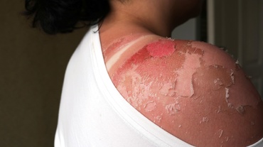 Arsurile solare în sarcină: riscuri și tratament