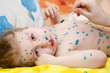 Dr. pediatru Mihai Craiu: Ce să NU facem în cazul în care copilul are varicelă – Nu petreceri cu varicelă, ci izolare strictă