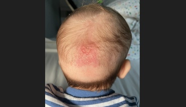 Dermatofitoza sau pecinginea la bebeluși: cauze, simptome și tratament