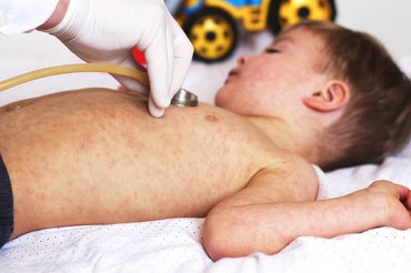 Ministerul Sănătății a declarat epidemie de rujeolă în România