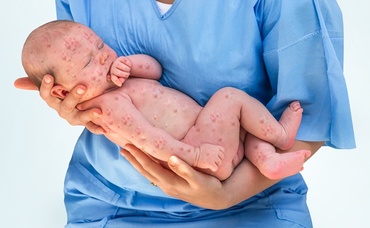 A fost înregistrat primul deces de rujeolă. Bebelușul avea doar 7 luni și a luat boala de la fratele mai mare, nevaccinat