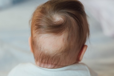 Cauzele căderii părului (alopecia), la bebeluși și copii
