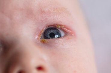 Canal lacrimal înfundat la bebeluși. Ce este de făcut