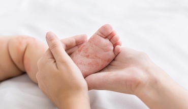 Un copil de 18 luni, vaccinat cu o doză ROR, a murit de rujeolă. Aproape 800 de noi îmbolnăviri, în ultima săptămână