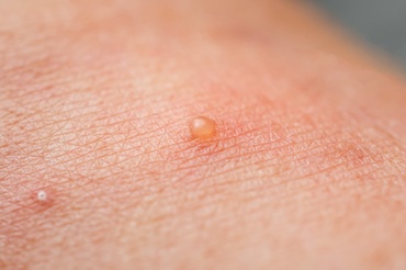 Dishidroza la copii, vara: cum să gestionați și să preveniți erupțiile