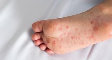 Boala gură–mână–picior: ce trebuie să știe părinții despre virusul care circulă acum în rândul copiilor