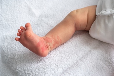 Boala gură-mână-picior la bebeluși: ce se întâmplă de fapt și cum treci mai ușor prin ea