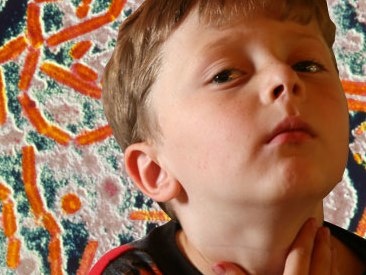 Parotidita epidemica oreion