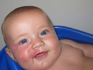 Semne din nastere - investigatii