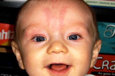 Semne din nastere - investigatii si tratament