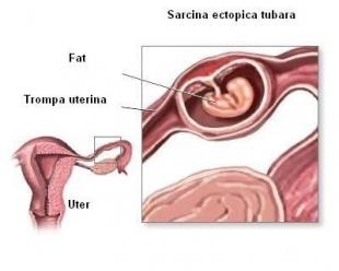 Cauze, riscuri si diagnostic pentru sarcina extrauterina