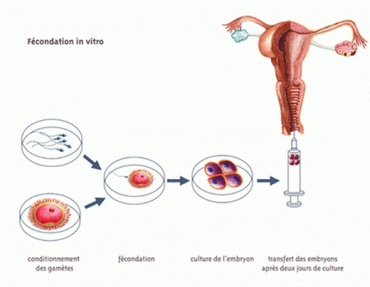 Fertilizarea in vitro