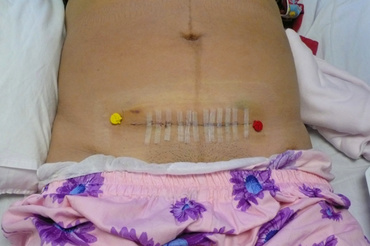 O alternativa la nasterea vaginala: cezariana