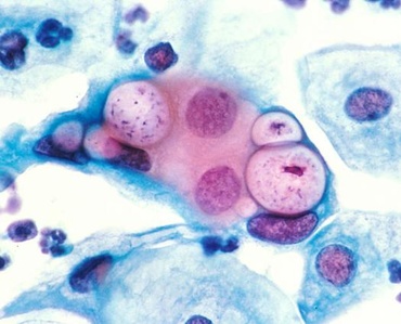 Infectia cu Chlamydia - riscuri si tratament