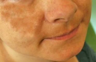 Pete si decolorari ale pielii