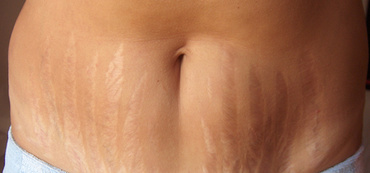 Vergeturile in sarcina - prevenire si tratament