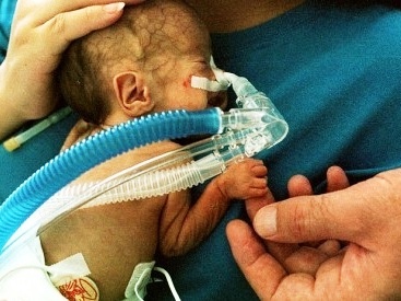 Nasterile inainte de termen, in crestere