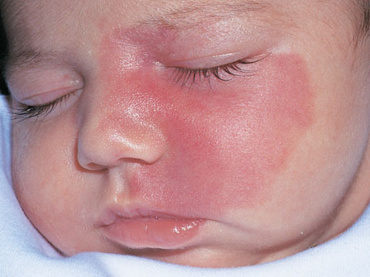 Cele mai intalnite semne din nastere