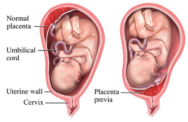 Placenta previa, tot ce trebuie sa stii 