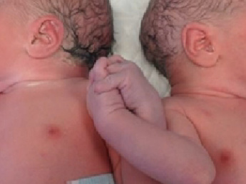 Gemenii care se tin de mana, dupa nastere