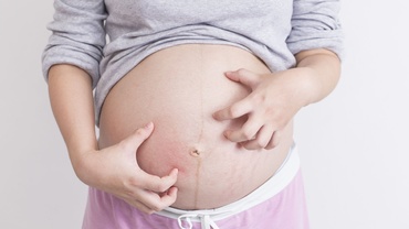 Varicela in sarcina - simptome si tratament