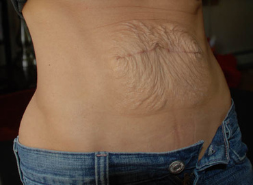 Pielea incretita de pe burta