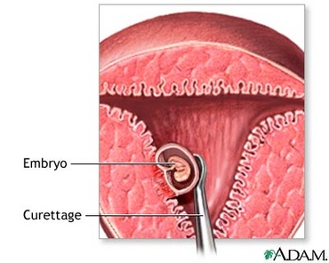 Avortul terapeutic