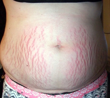 Sapte pasi ca sa eviti semnele de sarcina pe abdomen