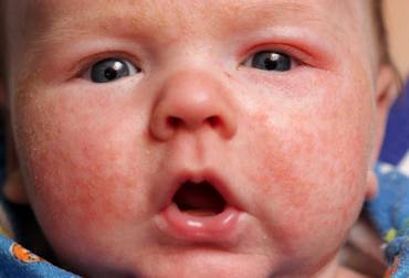 Ce este dermatita atopica la copii?