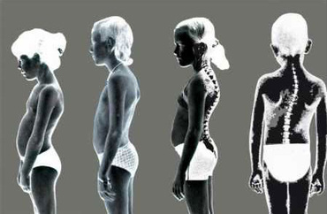 Copilul cocosat si pozitia corecta