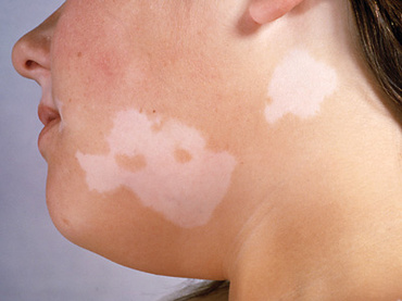 Vitiligo, petele albe care nu trec