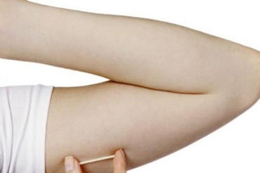 Contraceptie prin implant subdermic